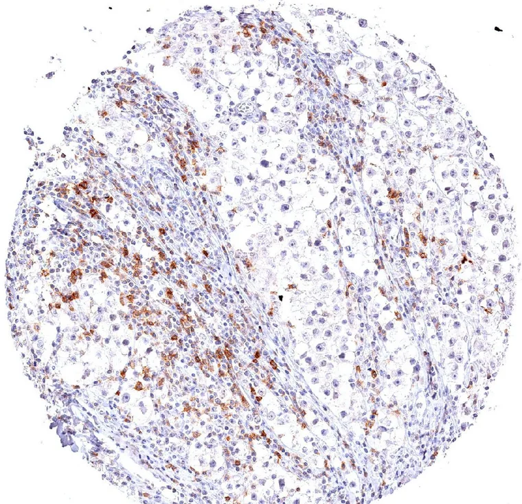Strong TIGIT expression in a large number of tumor infiltrating lymphocytes in a seminoma with dense lymphocytic infiltrate.