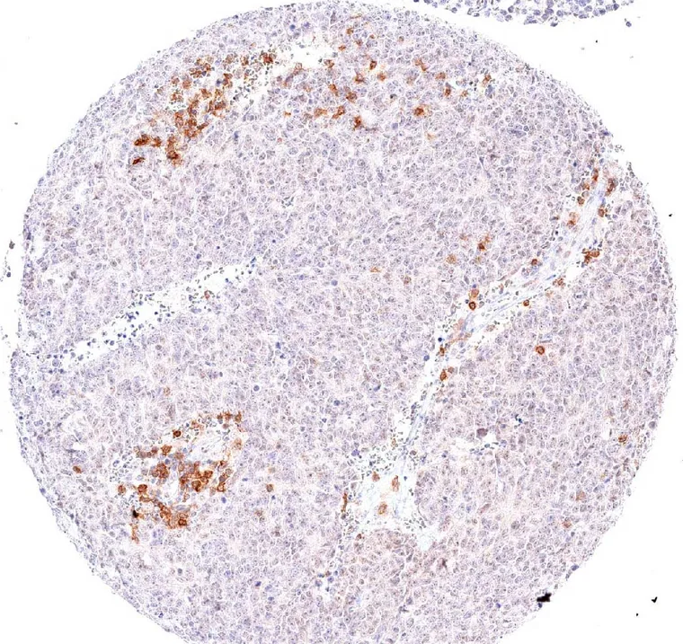 High grade neuroendocrine carcinoma with focal accumulation of TIGIT positive lymphocytes.