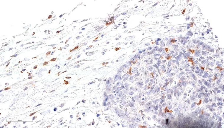 Dense peritumoral and intratumoral infiltrate of TIGIT positive lymphocytes in a case of a poorly differentiated squamous cell carcinoma of the esophagus.