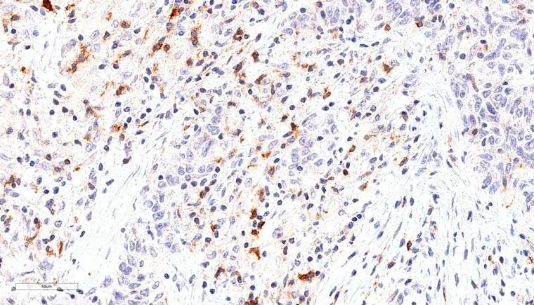 High frequency of TIGIT positive lymphocytes in a lymphoepithelial carcinoma.