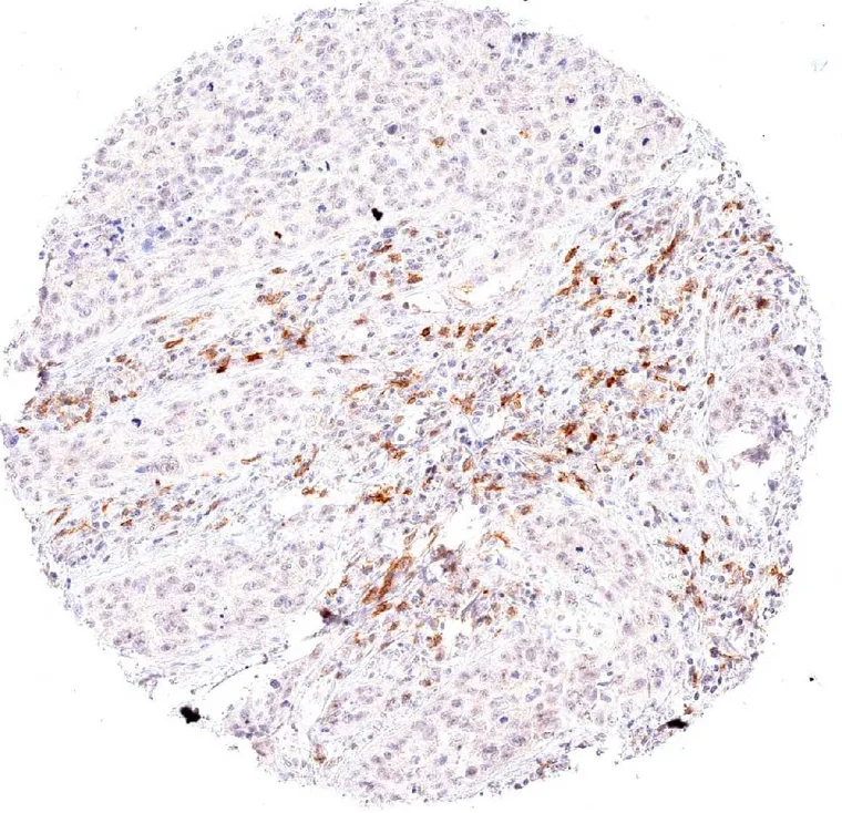 Dense peritumoral infiltrate of TIGIT positive lymphocytes in a laryngeal squamous cell carcinoma.