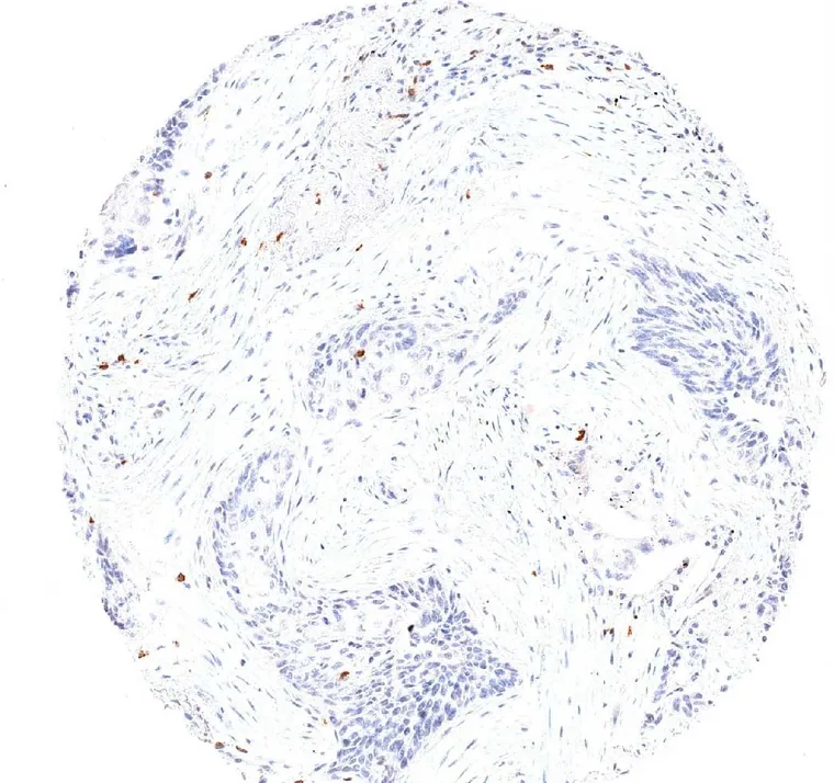 Sparse TIGIT positive lymphocytes in a squamous cell carcinoma of the lung with strong desmoplastic reaction.