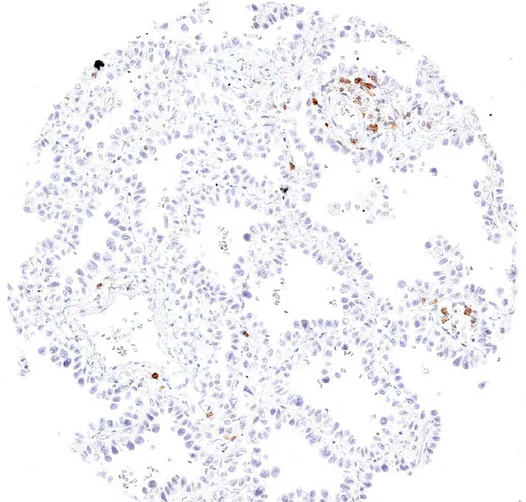 TIGIT positive lymphocytes in a bronchioloalveolar carcinoma of the lung.
