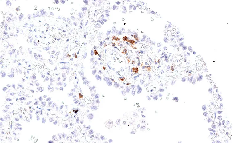 TIGIT positive lymphocytes in a bronchioloalveolar carcinoma of the lung.