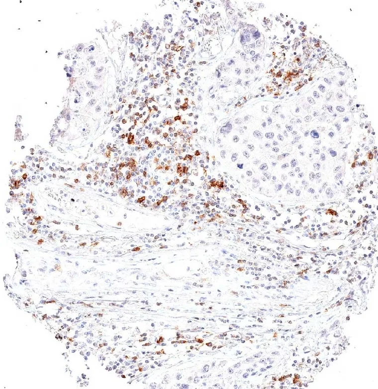High frequency of peritumoral TIGIT positive lymphocytes in a large cell adenocarcinoma of the lung.