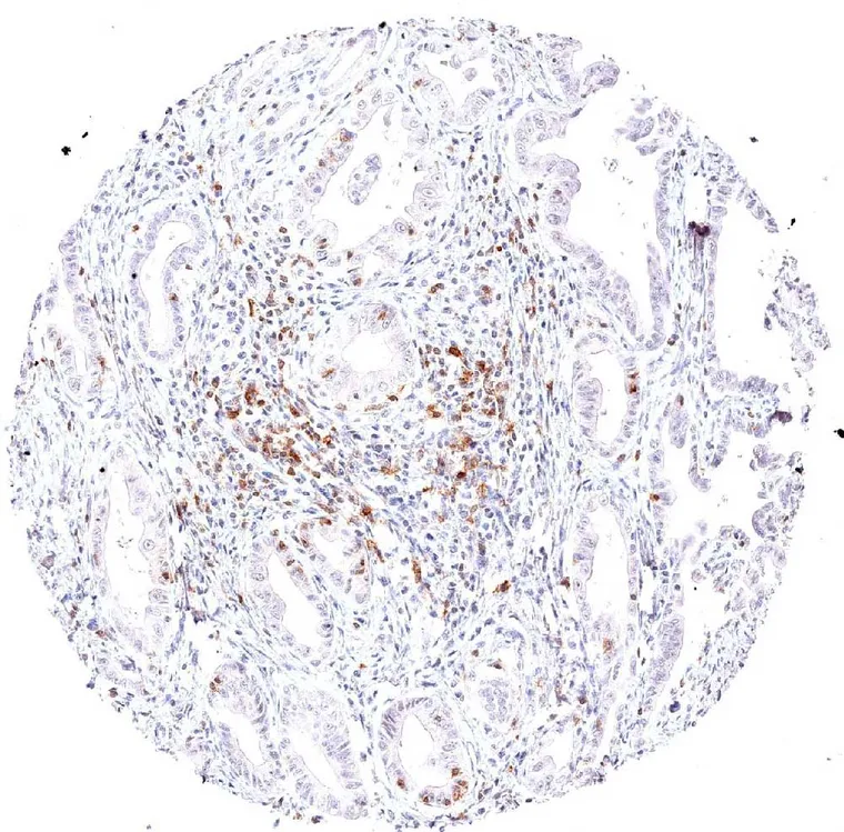 Abundant TIGIT positive lymphocytes in an adenocarcinoma of the ampulla of Vater.