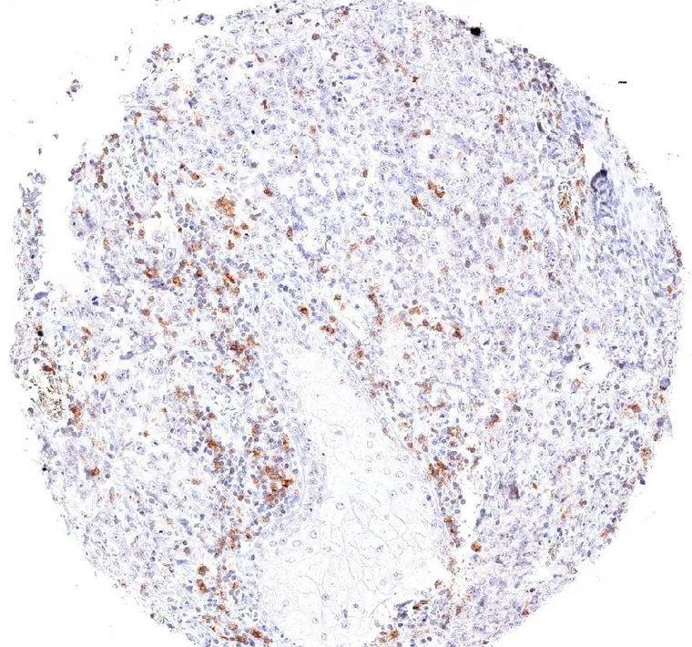 High number of TIGIT positive lymphocytes in an angiosarcoma.