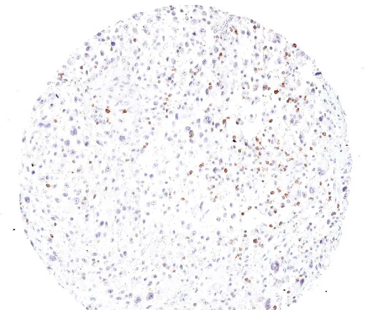 Frequent TIGIT positive lymphocytes in a liposarcoma.