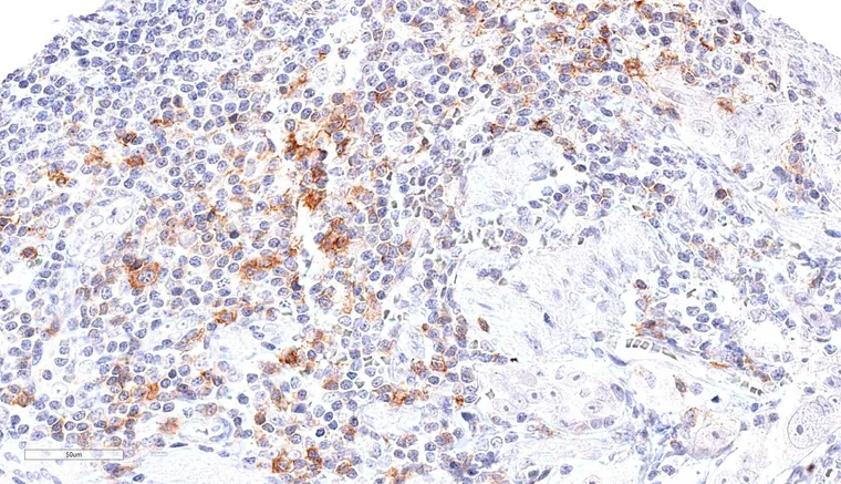 Dense infiltration of an ovarian carcinoma by TIGIT positive lymphocytes.