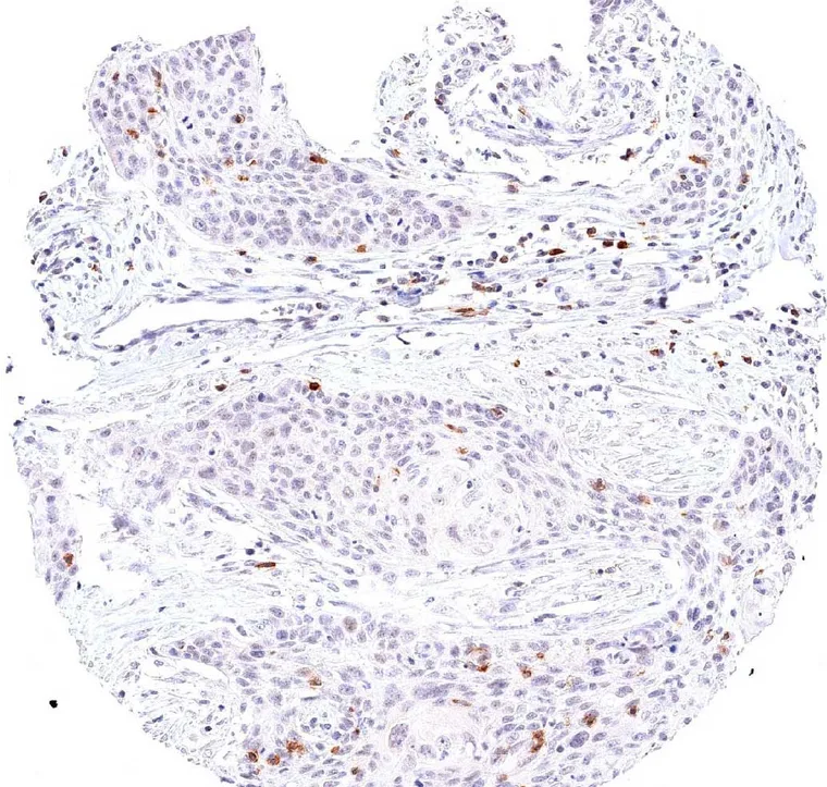Squamous cell carcinoma of the uterine cervix with peritumoral and intratumoral infiltrate of TIGIT positive lymphocytes.