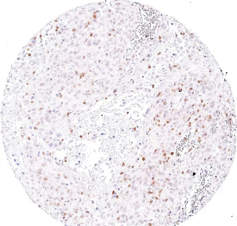 Squamous cell carcinoma of the uterine cervix with a high number of intratumoral TIGIT positive lymphocytes.
