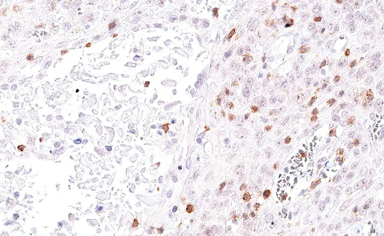 Squamous cell carcinoma of the uterine cervix with a high number of intratumoral TIGIT positive lymphocytes.