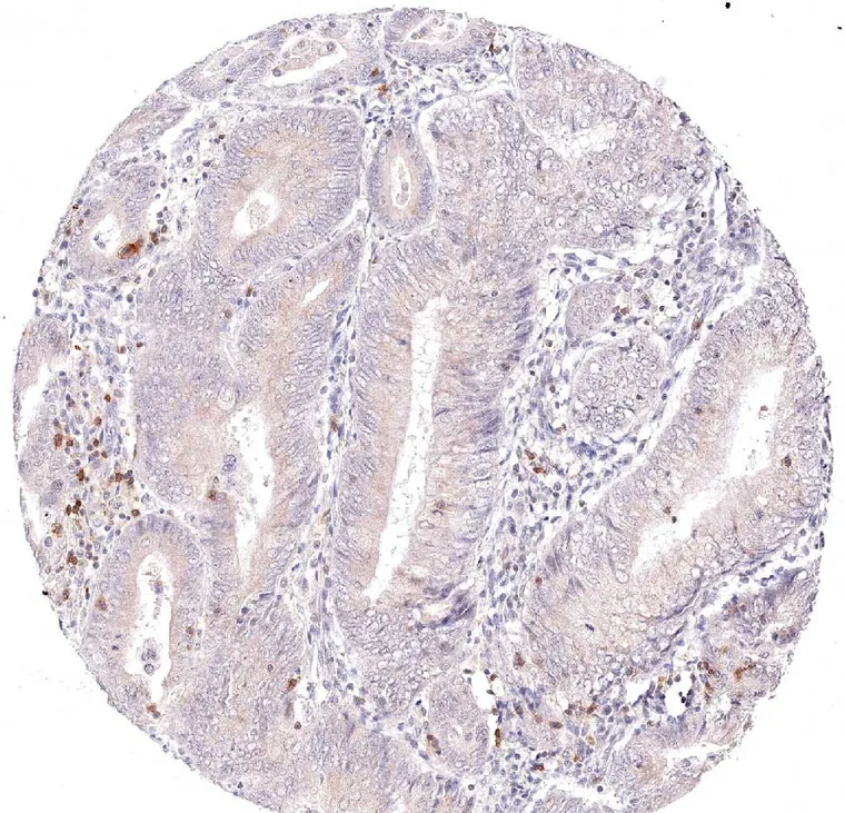 Peritumoral TIGIT positive lymphocytes in a case of endometrium carcinoma.