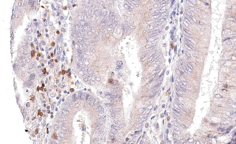 Peritumoral TIGIT positive lymphocytes in a case of endometrium carcinoma.