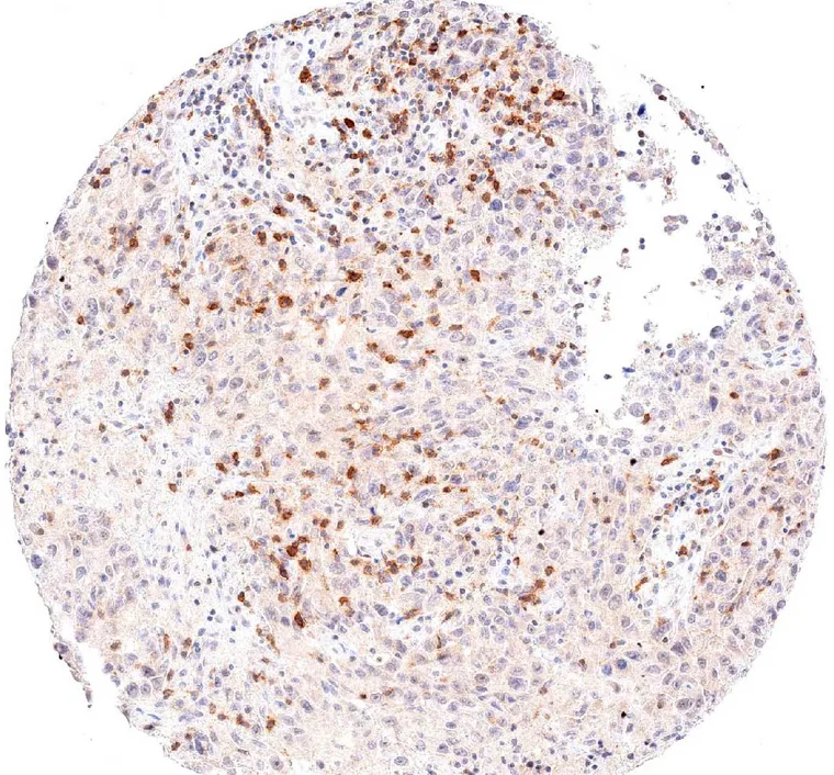 High density of TIGIT positive lymphocytes in a medullary breast cancer.