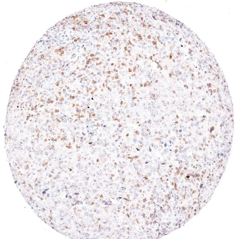 A case of medullary breast cancer with abundant TIGIT positive lymphocytes.