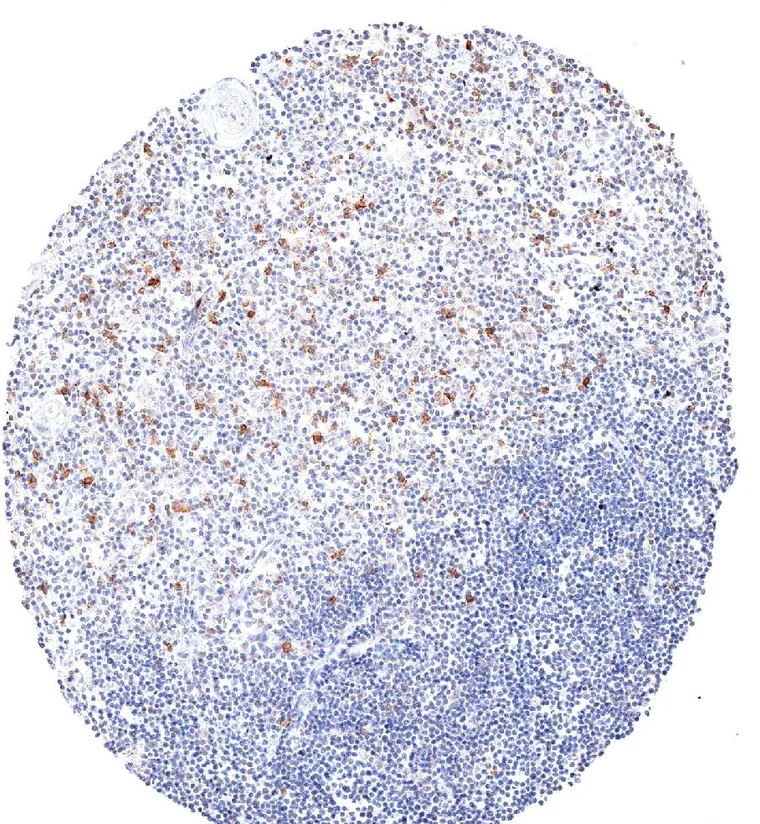 Thymus with high number of TIGIT positive lymphocytes.
