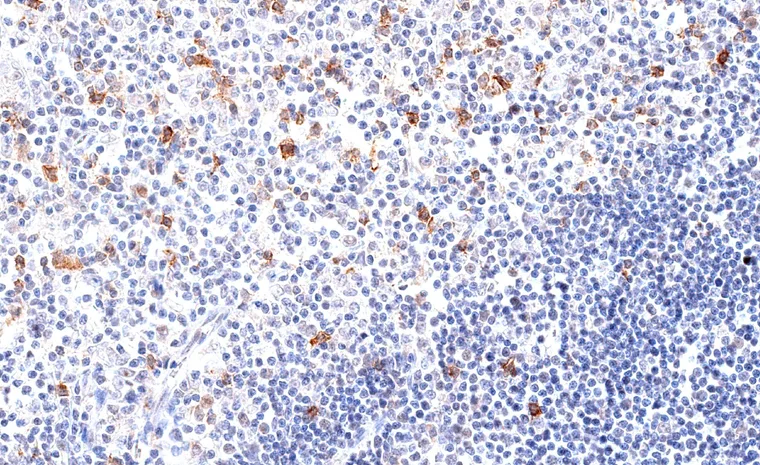 Thymus with high number of TIGIT positive lymphocytes.
