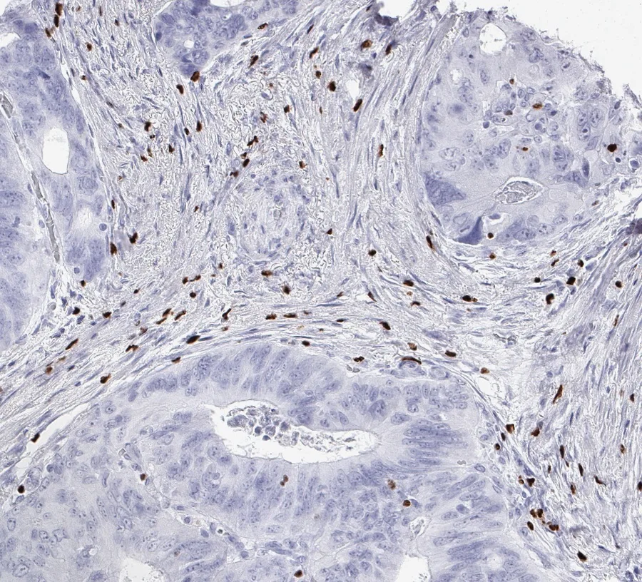 Immunohistochemistry of human FOXP3 with anti-FOXP3 clone FX3 (DIA-FX3) in FFPE tissue – FOXP3-positive regulatory T cells in the stroma of a colorectal adenocarcinoma; figure 03 of the ONCOdianova FOXP3 gallery and figure A of the datasheet.