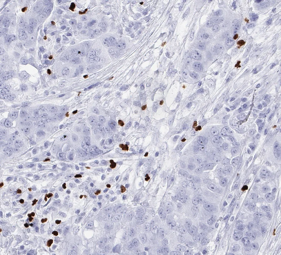 Immunohistochemistry of human FOXP3 with anti-FOXP3 clone FX3 (DIA-FX3) in FFPE tissue – FOXP3-positive tumour-infiltrating lymphocytes in a high-grade serous ovarian carcinoma; figure 04 of the ONCOdianova FOXP3 gallery and figure B of the datasheet.