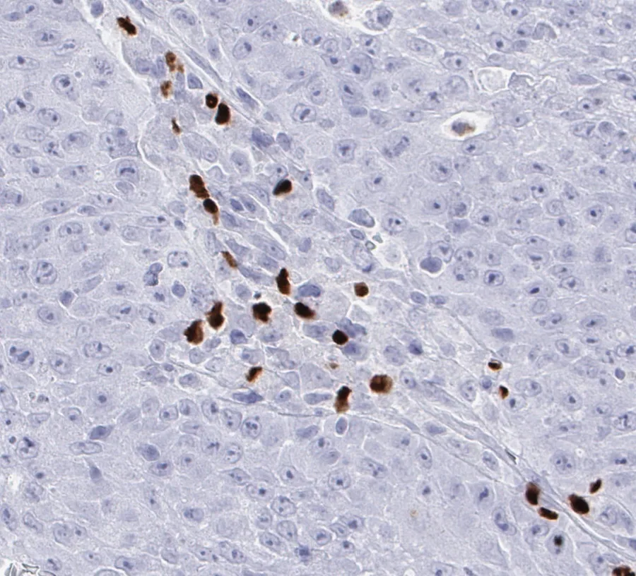 Immunohistochemistry of human FOXP3 with anti-FOXP3 clone FX3 (DIA-FX3) in FFPE tissue – focal accumulation of FOXP3-positive tumour-infiltrating lymphocytes in a solid cancer (pancreatic carcinoma), 40×; figure 05 of the ONCOdianova FOXP3 gallery.