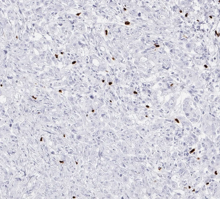 Immunohistochemistry of human FOXP3 with anti-FOXP3 clone FX3 (DIA-FX3) in FFPE tissue – FOXP3-positive tumour-infiltrating lymphocytes in stomach carcinoma, 20×; figure 06 of the ONCOdianova FOXP3 gallery.