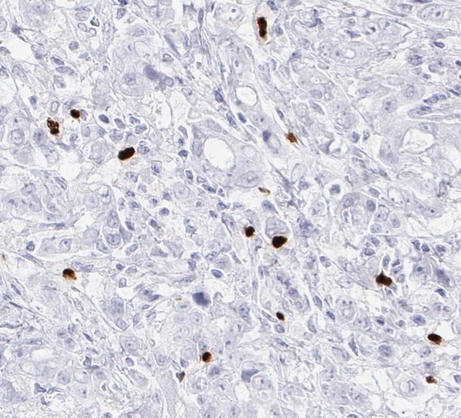 Immunohistochemistry of human FOXP3 with anti-FOXP3 clone FX3 (DIA-FX3) in FFPE tissue – higher magnification of the same cancer as in figure 06; note the optimal signal-to-noise ratio of the immunostaining. Stomach carcinoma, 40×; figure 07 of the ONCOdianova FOXP3 gallery.