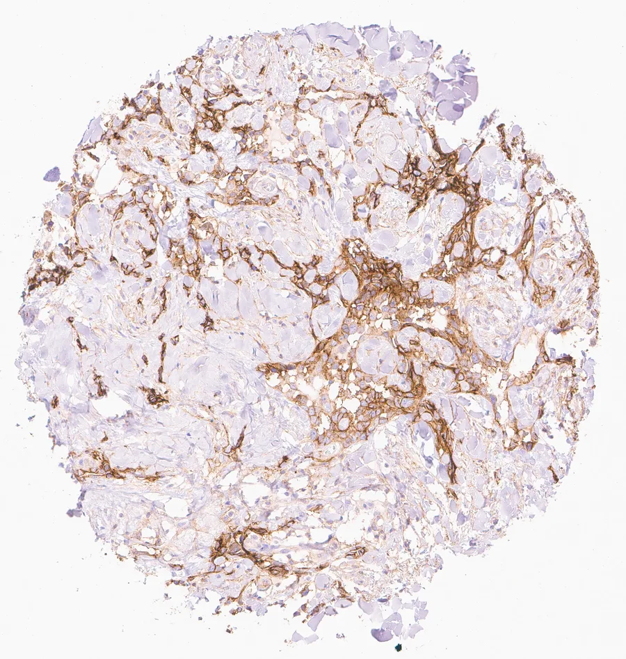 Immunohistochemistry of human CD73 (NT5E) with anti-CD73 clone KK3 (DIA-KK3) in FFPE tissue – strong membranous CD73 staining in an angiosarcoma; figure 08 of the ONCOdianova CD73 gallery.