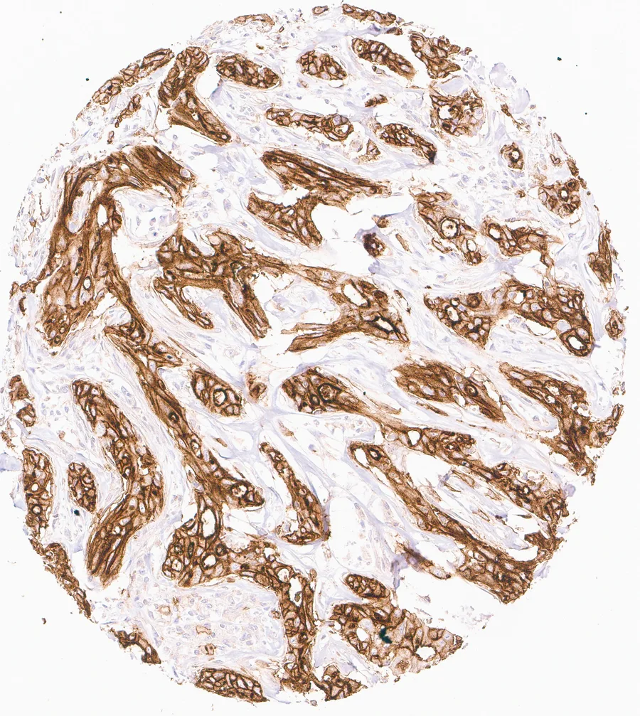 Immunohistochemistry of human CD73 (NT5E) with anti-CD73 clone KK3 (DIA-KK3) in FFPE tissue – strong homogeneous CD73 immunostaining in a cholangiocellular carcinoma of the liver; figure 01 of the ONCOdianova CD73 gallery.