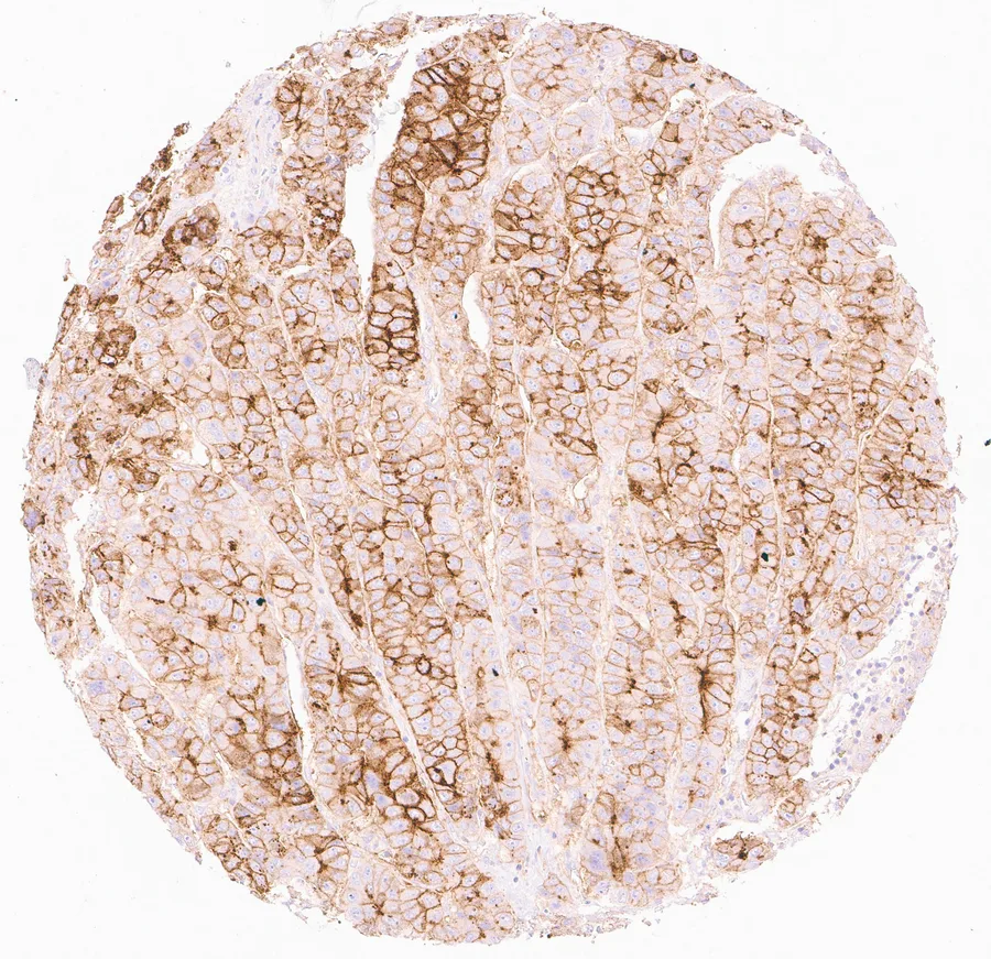 Immunohistochemistry of human CD73 (NT5E) with anti-CD73 clone KK3 (DIA-KK3) in FFPE tissue – membranous CD73 positivity with a heterogeneous pattern in a hepatocellular carcinoma of the liver; figure 02 of the ONCOdianova CD73 gallery.