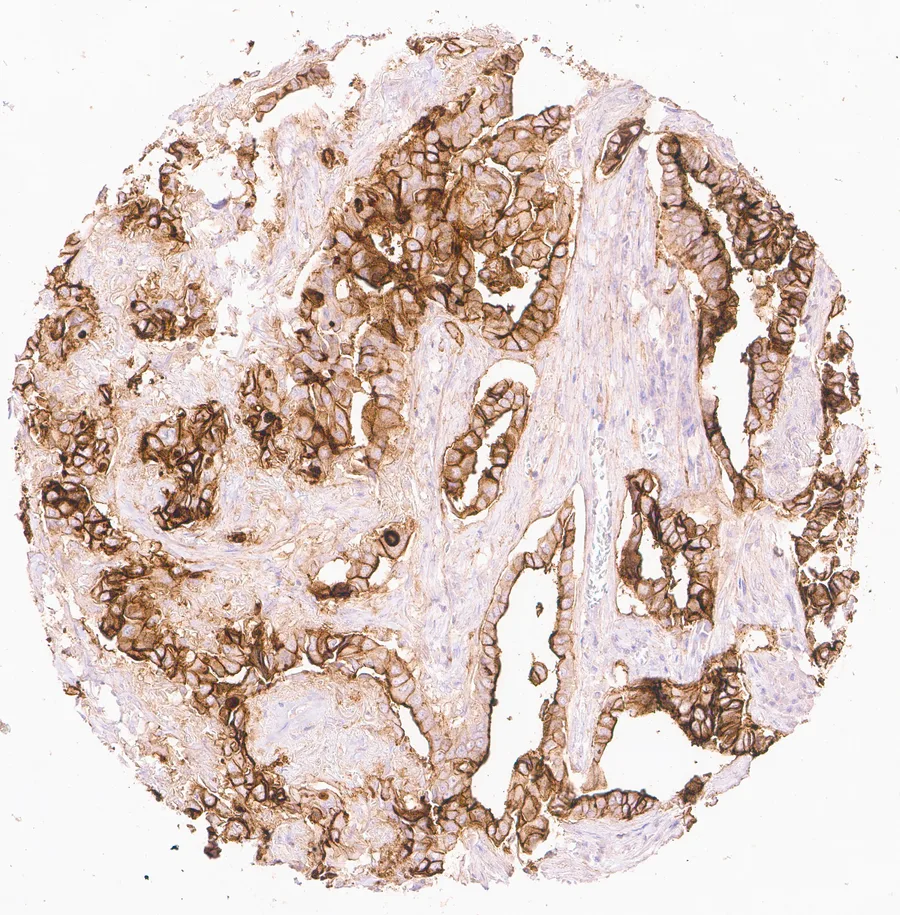 Immunohistochemistry of human CD73 (NT5E) with anti-CD73 clone KK3 (DIA-KK3) in FFPE tissue – membranous CD73 immunostaining with apical predominance in an adenocarcinoma of the lung; figure 04 of the ONCOdianova CD73 gallery.