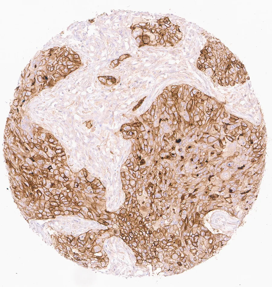 Immunohistochemistry of human CD73 (NT5E) with anti-CD73 clone KK3 (DIA-KK3) in FFPE tissue – strong diffuse CD73 positivity in a squamous cell carcinoma of the lung; figure 05 of the ONCOdianova CD73 gallery.