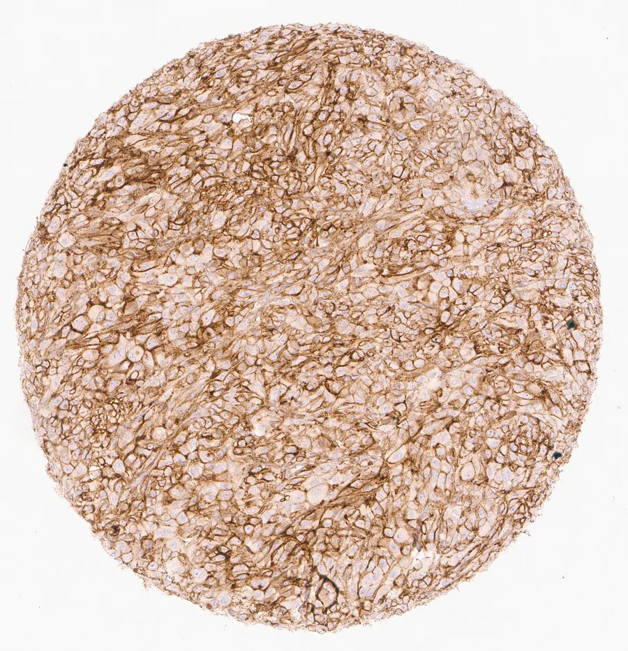 Immunohistochemistry of human CD73 (NT5E) with anti-CD73 clone KK3 (DIA-KK3) in FFPE tissue – prominent membranous CD73 positivity in a malignant melanoma; figure 03 of the ONCOdianova CD73 gallery.