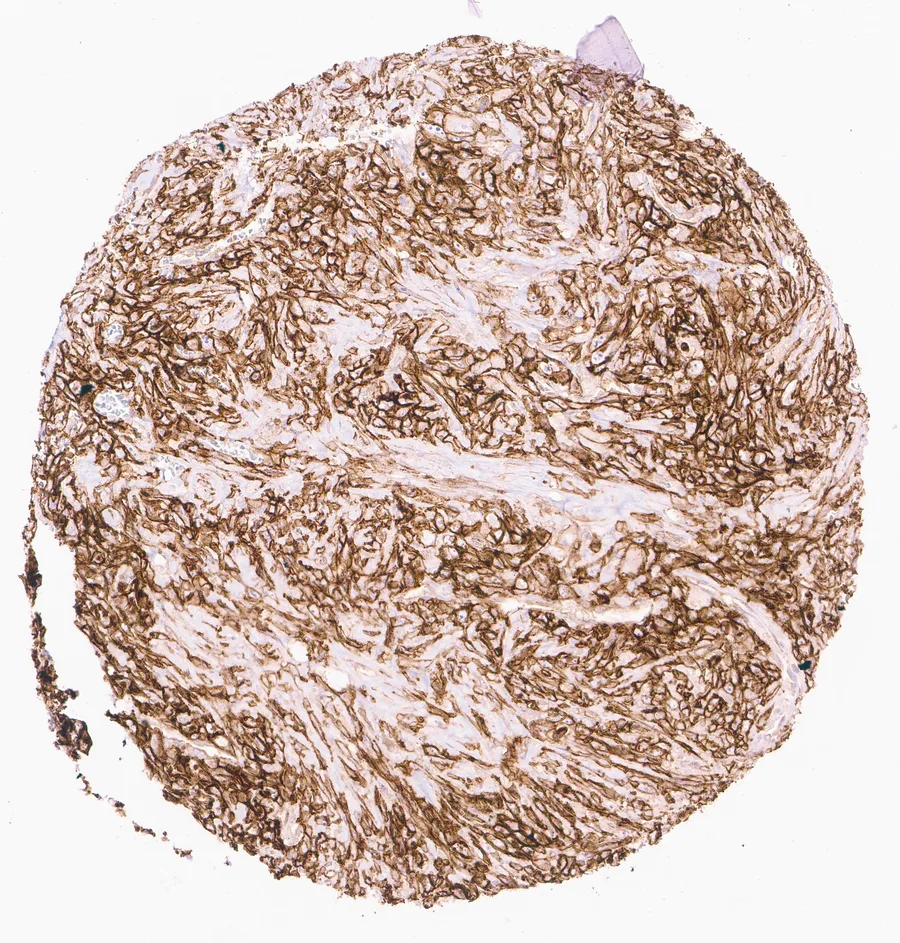Immunohistochemistry of human CD73 (NT5E) with anti-CD73 clone KK3 (DIA-KK3) in FFPE tissue – CD73 immunostaining in a mixed tumor of the lung; figure 06 of the ONCOdianova CD73 gallery.