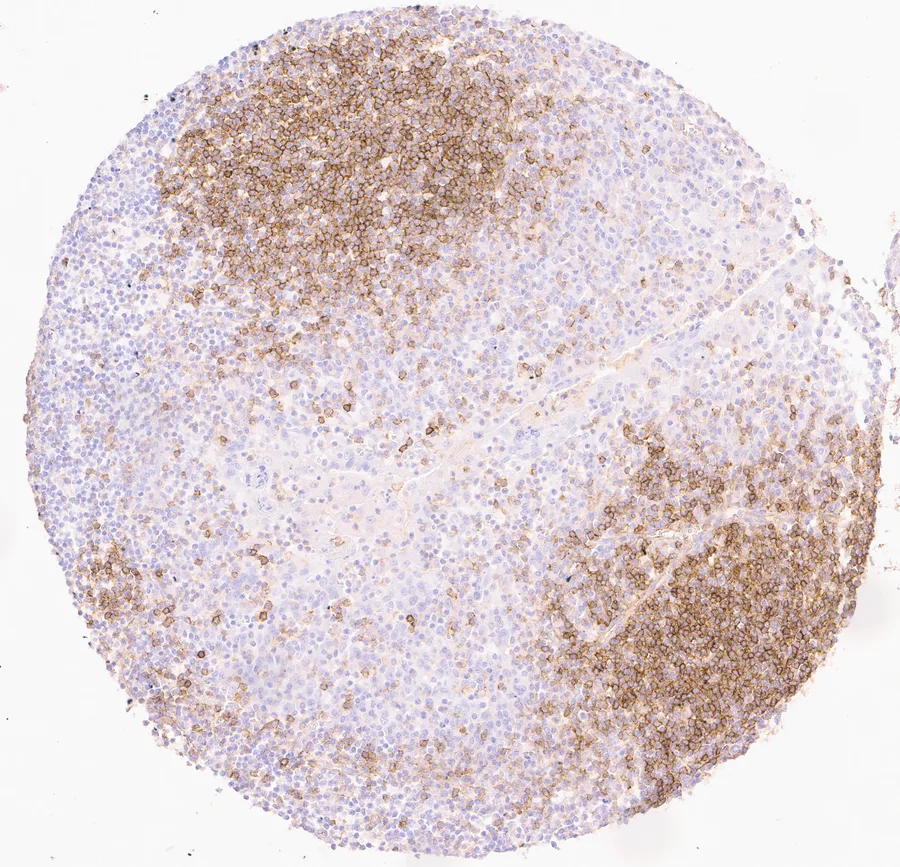 Immunohistochemistry of human CD73 (NT5E) with anti-CD73 clone KK3 (DIA-KK3) in FFPE tissue – CD73 immunostaining in tonsil, the positive-control tissue of the datasheet; figure 07 of the ONCOdianova CD73 gallery.