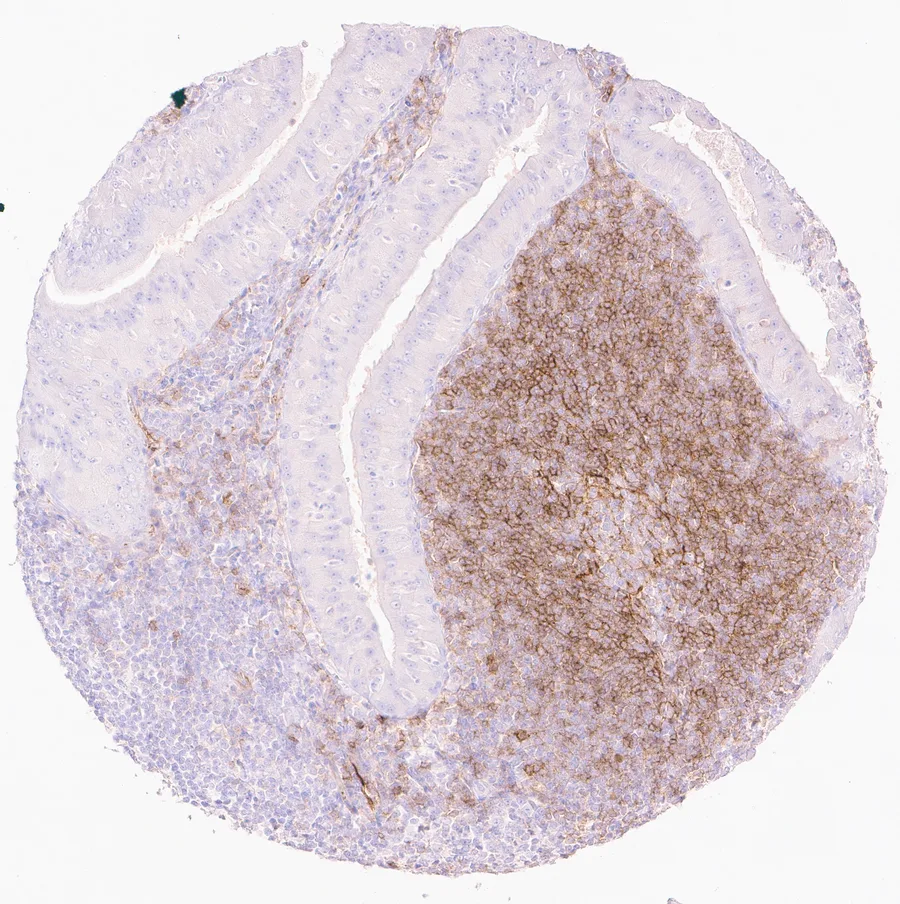 Immunohistochemistry of human CD73 (NT5E) with anti-CD73 clone KK3 (DIA-KK3) in FFPE tissue – distinct CD73 staining in lymphocytes in a Warthin tumor of the parotid gland; figure 10 of the ONCOdianova CD73 gallery.