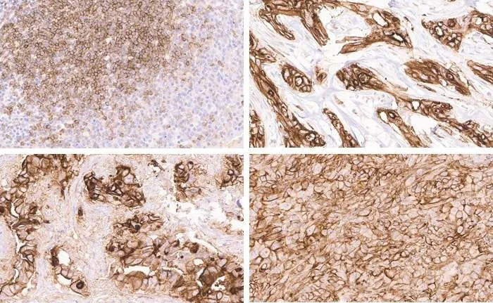 Datasheet DIA-KK3, figures A–D: immunohistochemistry of human CD73 with clone KK3 in routine FFPE tissue – A tonsil, B strong homogeneous CD73 immunostaining in a cholangiocellular carcinoma of the liver, C membranous CD73 immunostaining with apical predominance in an adenocarcinoma of the lung, D prominent membranous CD73 positivity in a malignant melanoma.