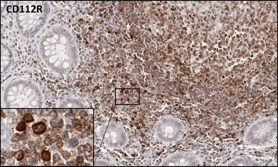 Immunohistochemistry of human CD112R/PVRIG with anti-CD112R/PVRIG clone R12 (DIA-R12) – brightfield IHC of normal human tonsil with numerous CD112R/PVRIG-positive lymphocytes (datasheet DIA-R12, figure A, same photographic field); figure 03 of the ONCOdianova CD112R gallery.