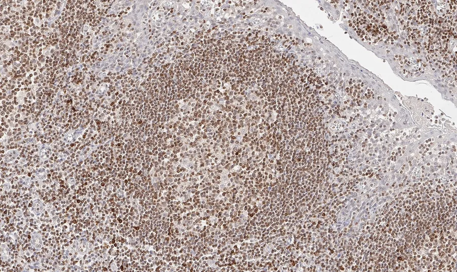 Immunohistochemistry of human CD112R/PVRIG with anti-CD112R/PVRIG clone R12 (DIA-R12) in FFPE tissue – brightfield IHC, figure 04 of the ONCOdianova CD112R gallery.