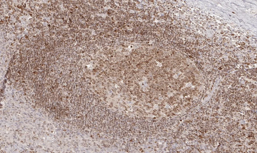 Immunohistochemistry of human CD112R/PVRIG with anti-CD112R/PVRIG clone R12 (DIA-R12) in FFPE tissue – brightfield IHC, figure 05 of the ONCOdianova CD112R gallery.
