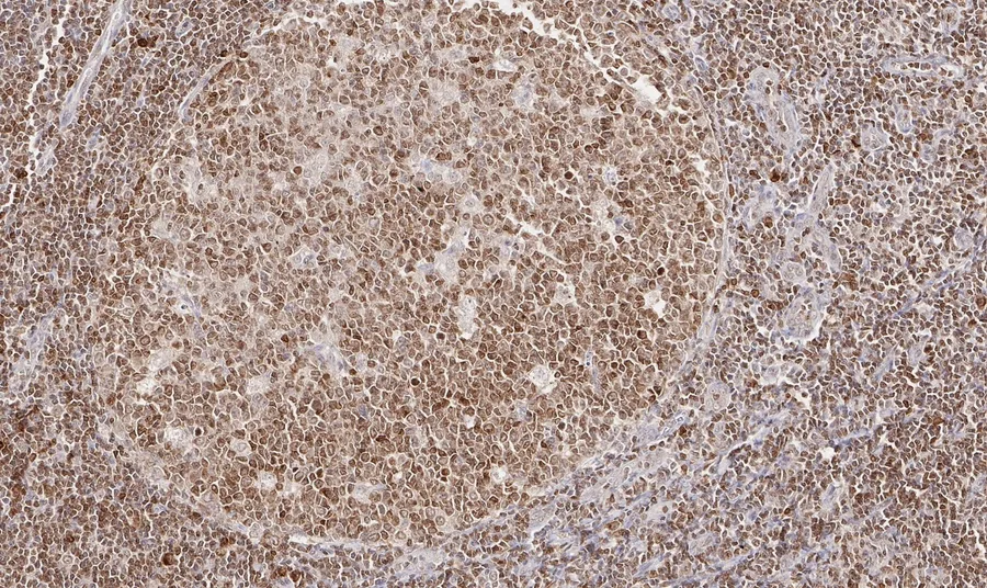 Immunohistochemistry of human CD112R/PVRIG with anti-CD112R/PVRIG clone R12 (DIA-R12) in FFPE tissue – brightfield IHC, figure 06 of the ONCOdianova CD112R gallery.