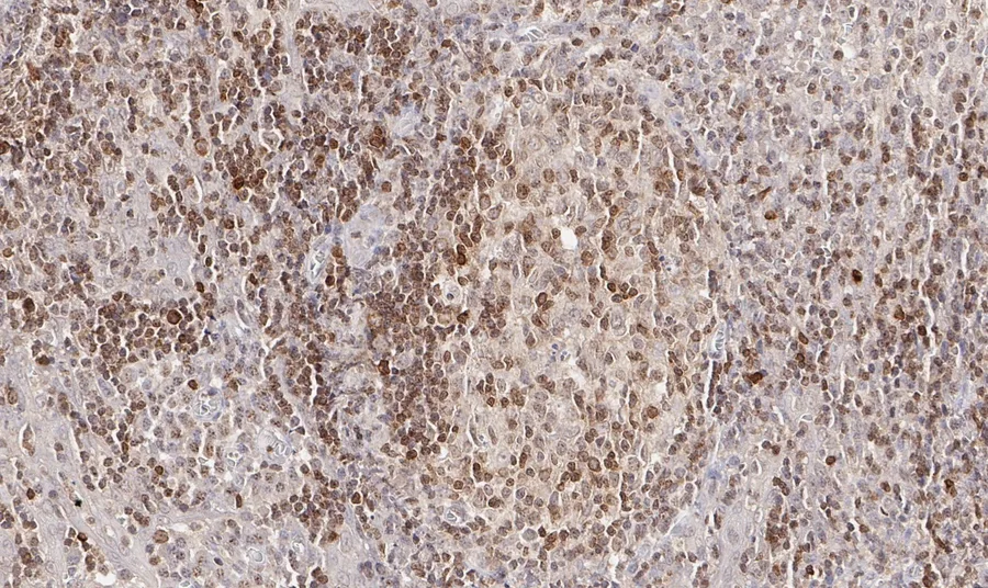 Immunohistochemistry of human CD112R/PVRIG with anti-CD112R/PVRIG clone R12 (DIA-R12) in FFPE tissue – brightfield IHC, figure 07 of the ONCOdianova CD112R gallery.