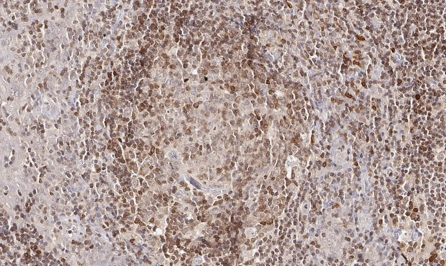 Immunohistochemistry of human CD112R/PVRIG with anti-CD112R/PVRIG clone R12 (DIA-R12) in FFPE tissue – brightfield IHC, figure 08 of the ONCOdianova CD112R gallery.