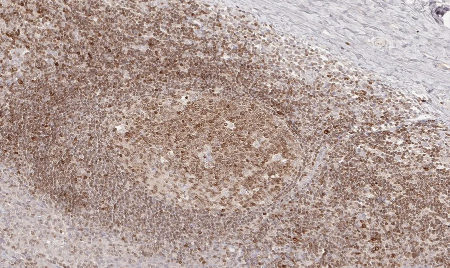 Immunohistochemistry of human CD112R/PVRIG with anti-CD112R/PVRIG clone R12 (DIA-R12) in FFPE tissue – brightfield IHC, figure 09 of the ONCOdianova CD112R gallery.