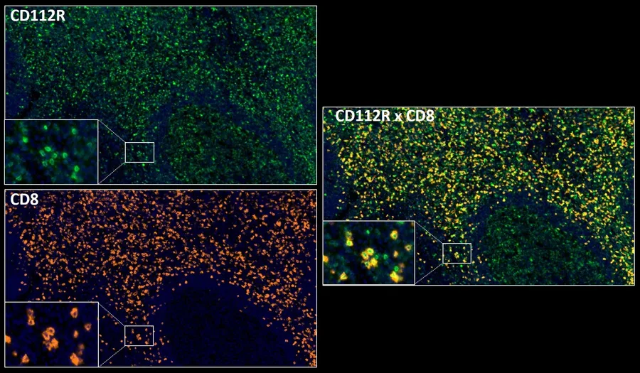 Fluorescence multiplex immunohistochemistry of CD112R/PVRIG (clone R12, DIA-R12; green) and CD8 (orange) in human FFPE tissue – single channels CD112R (green) and CD8 (orange) with detail insets, and overlay CD112R × CD8; figure 02 of the ONCOdianova CD112R gallery.