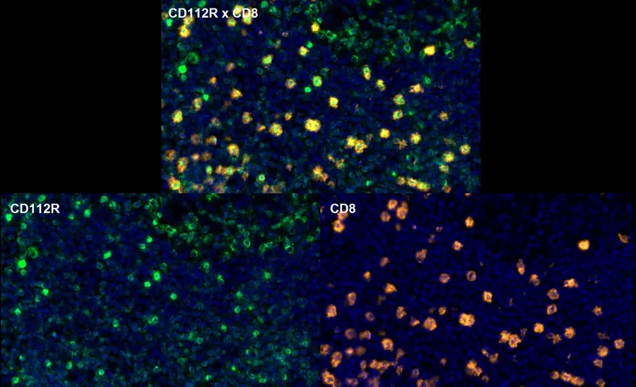Fluorescence multiplex immunohistochemistry of CD112R/PVRIG (clone R12, DIA-R12; green) and CD8 (orange) in human FFPE tissue – overlay CD112R × CD8 (top) and single channels CD112R and CD8 (bottom), higher magnification; figure 10 of the ONCOdianova CD112R gallery.