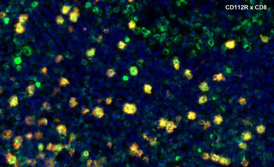 Fluorescence multiplex immunohistochemistry of CD112R/PVRIG (clone R12, DIA-R12; green) and CD8 (orange) in human FFPE tissue – overlay CD112R × CD8, higher magnification; double-positive cells appear yellow; figure 11 of the ONCOdianova CD112R gallery.