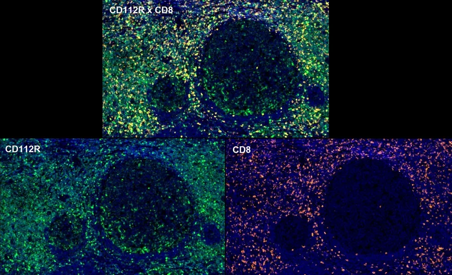 Fluorescence multiplex immunohistochemistry of CD112R/PVRIG (clone R12, DIA-R12; green) and CD8 (orange) in human FFPE tissue – overlay CD112R × CD8 (top) and single channels CD112R and CD8 (bottom) around lymphoid follicles; figure 12 of the ONCOdianova CD112R gallery.
