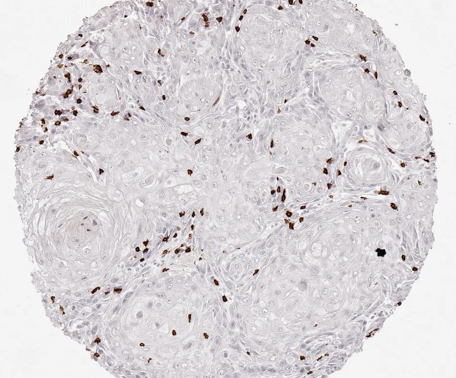 Immunohistochemistry of human CD8 with anti-CD8 clone TC8 (DIA-TC8) in FFPE tissue – scattered CD8-positive lymphocytes in anal squamous cell carcinoma; figure 29 of the ONCOdianova CD8 gallery.