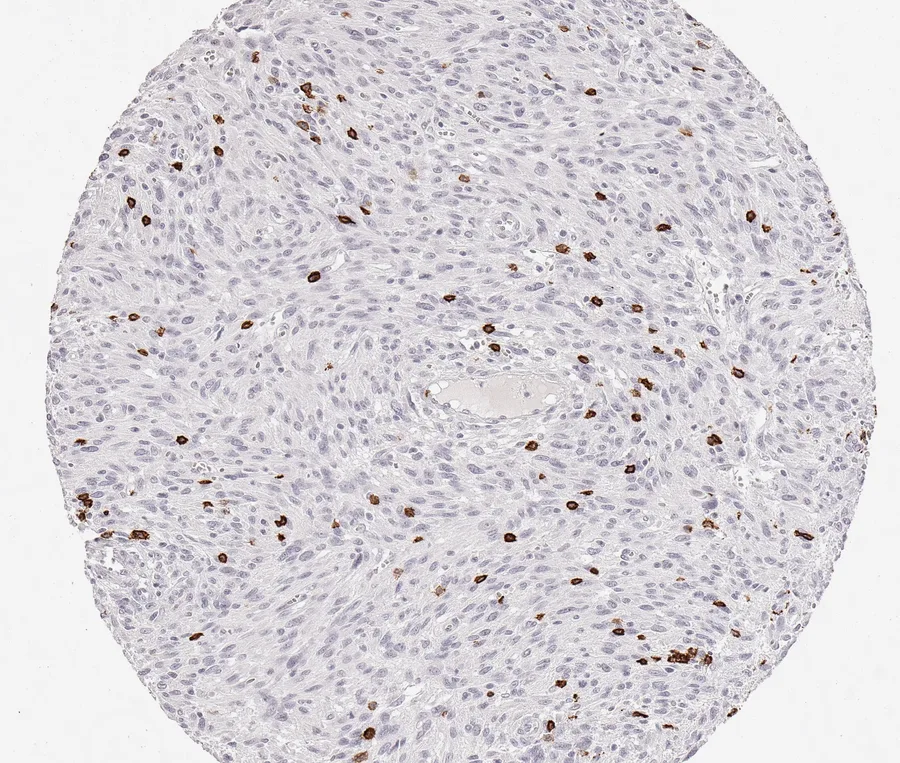 Immunohistochemistry of human CD8 with anti-CD8 clone TC8 (DIA-TC8) in FFPE tissue – CD8-positive lymphocytes in anal squamous cell carcinoma; figure 31 of the ONCOdianova CD8 gallery.